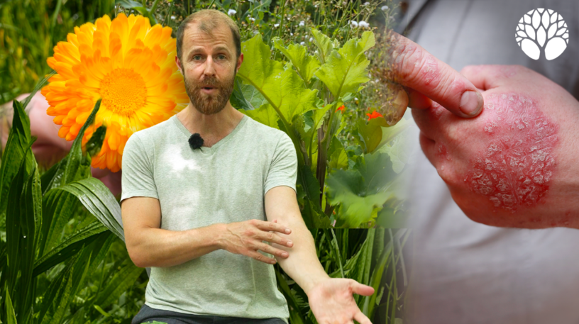Eczéma ou psoriasis : quelles plantes pour apaiser votre peau ?